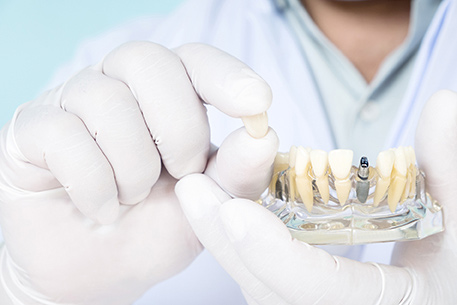Dentální implantáty